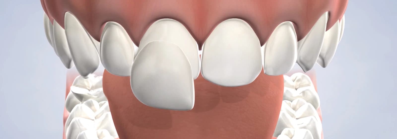 procedure-hero-desktop-veneers