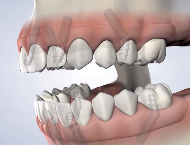 4-Hour Smile